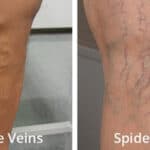 Spider & Varicose Veins