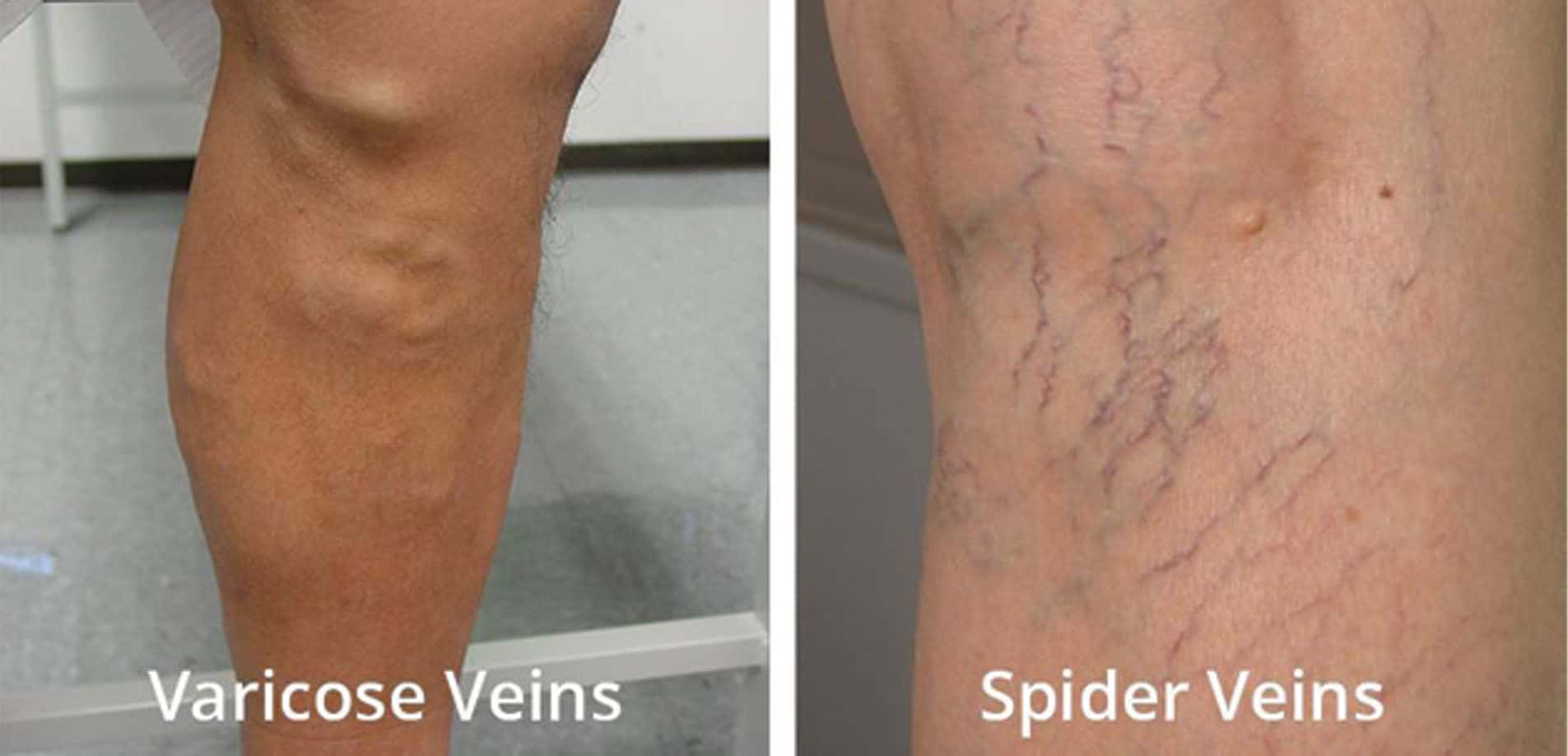 How to Prevent and Manage Varicose Veins • Southwest Florida's