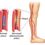 Cardiovascular Disorders