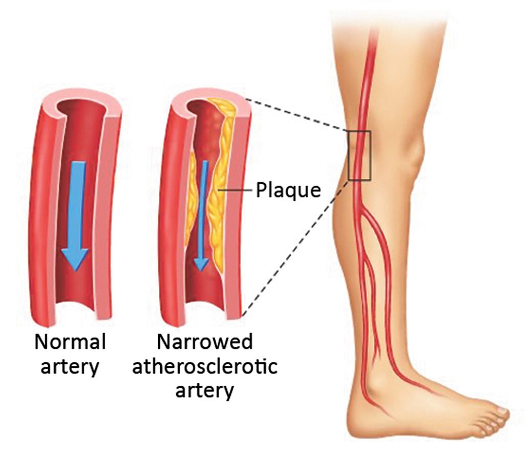 Cardiovascular Disorders