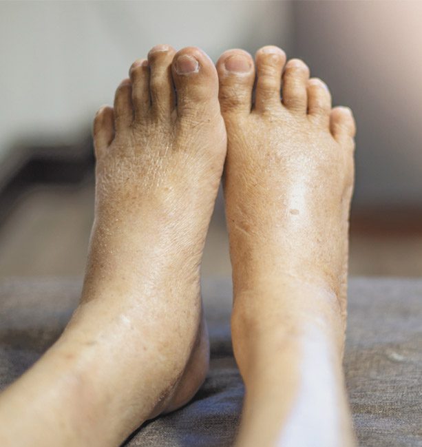 Diabetic Foot Infections