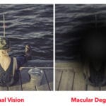 Macular Degeneration