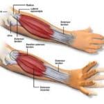 Tennis Elbow