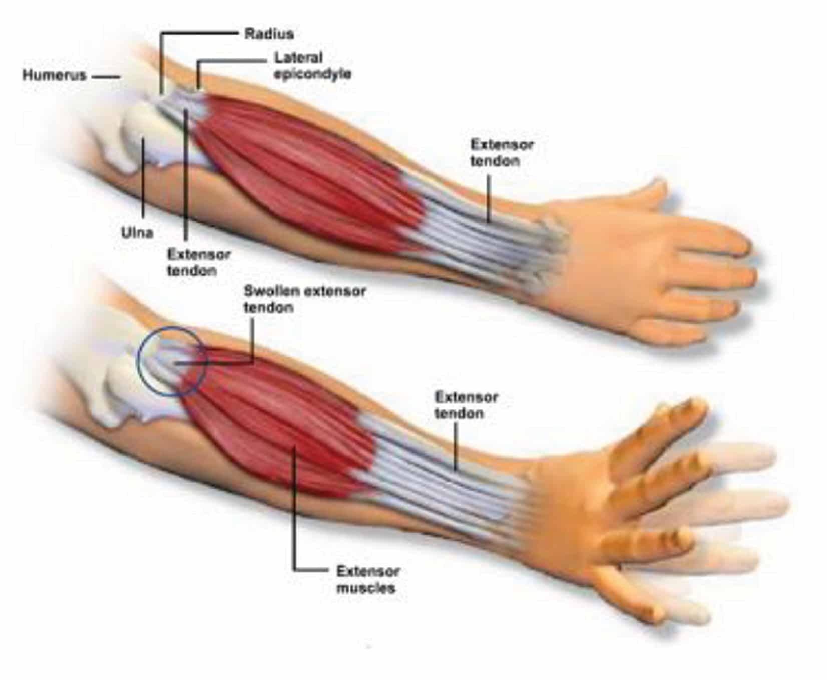 Tennis Elbow
