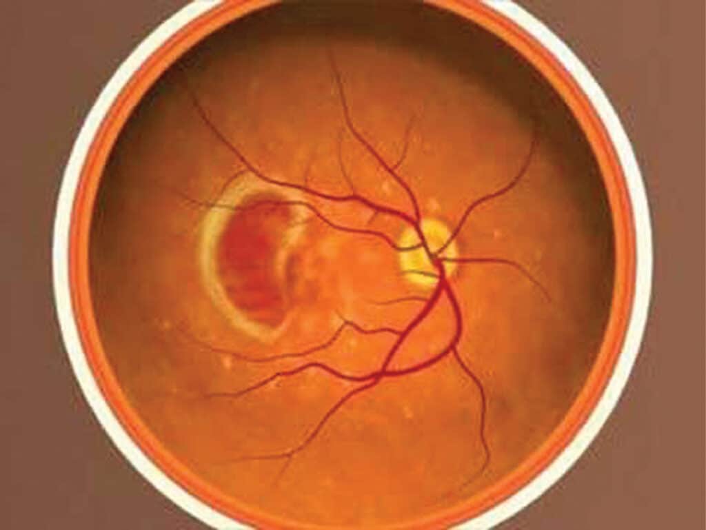 Macular Degeneration Role in the Disease • Southwest Florida