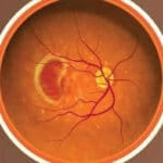 Macular Degeneration