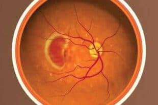 Macular Degeneration