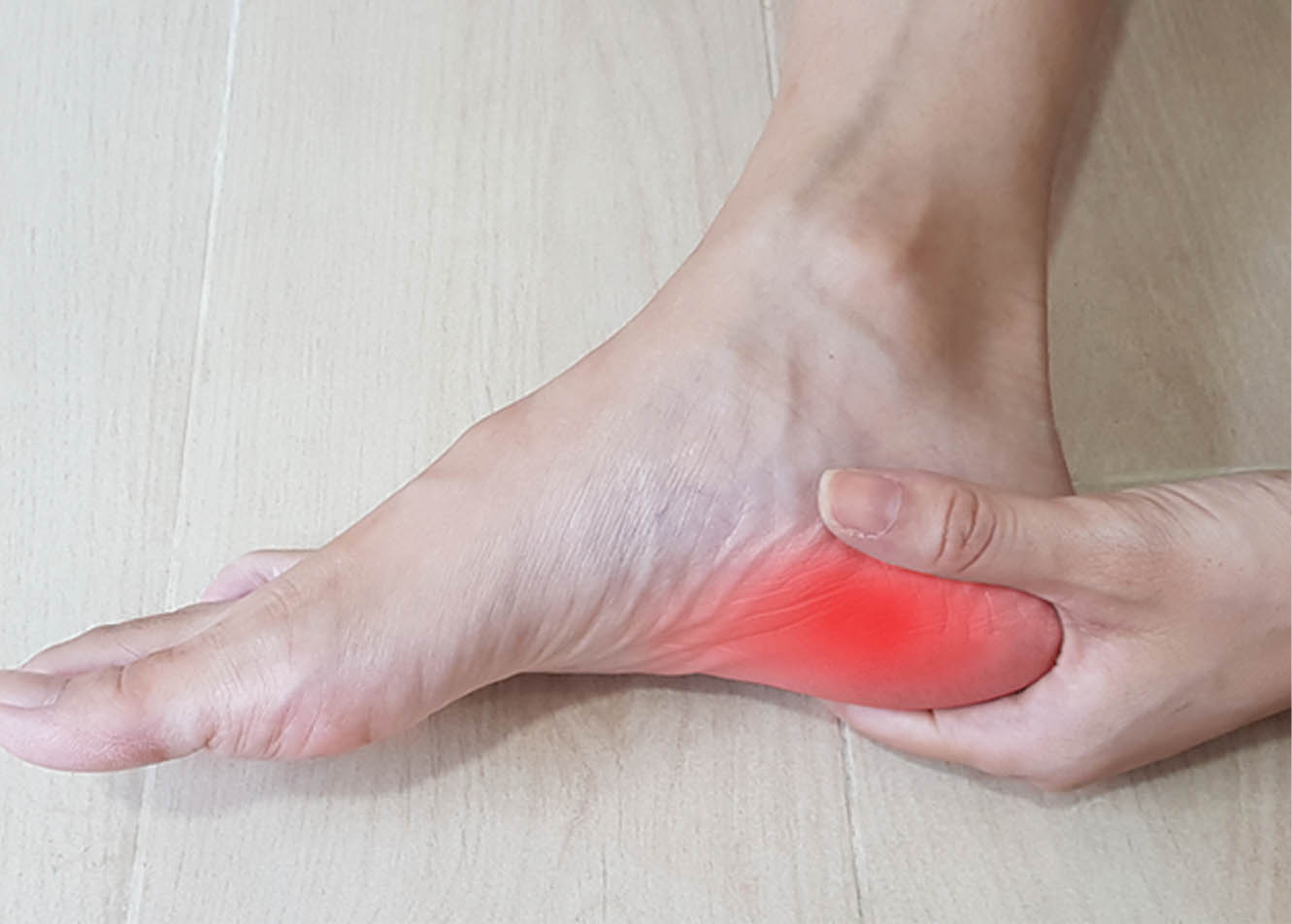 Plantar Fasciitis