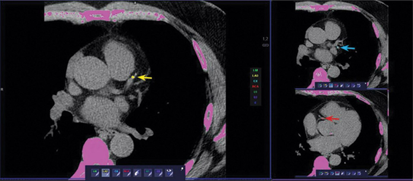 How a Calcium Score Test Can Offer Significant Hope for Your