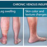 Varicose Veins