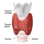 Thyroid