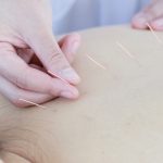 Acupuncture