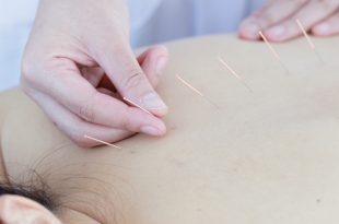 Acupuncture