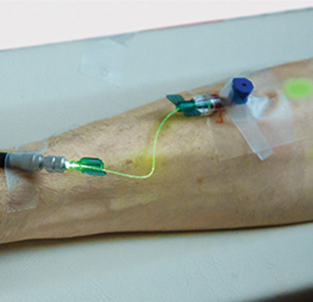 Inventive IV Laser Therapy Offers Numerous Possibilities to Enhance