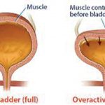 Overactive Bladder