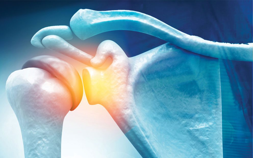 Rotator Cuff Tears: Do You Really Need Surgery? • Southwest Florida's ...