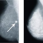 Dense Breast Tissue