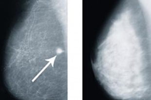 Dense Breast Tissue