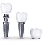 Implant Dentistry