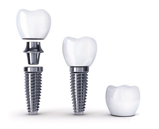 Implant Dentistry