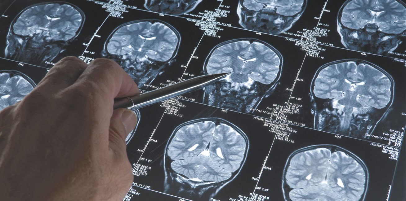 Treatment of Alzheimer’s