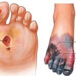 Chronic Limb Ischemia