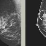 Advanced Mammography