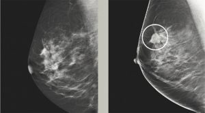 Advanced Mammography