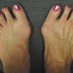 Bunions