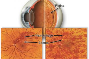 Central Retinal Vein Occlusion