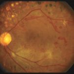 Diabetic Retinopathy