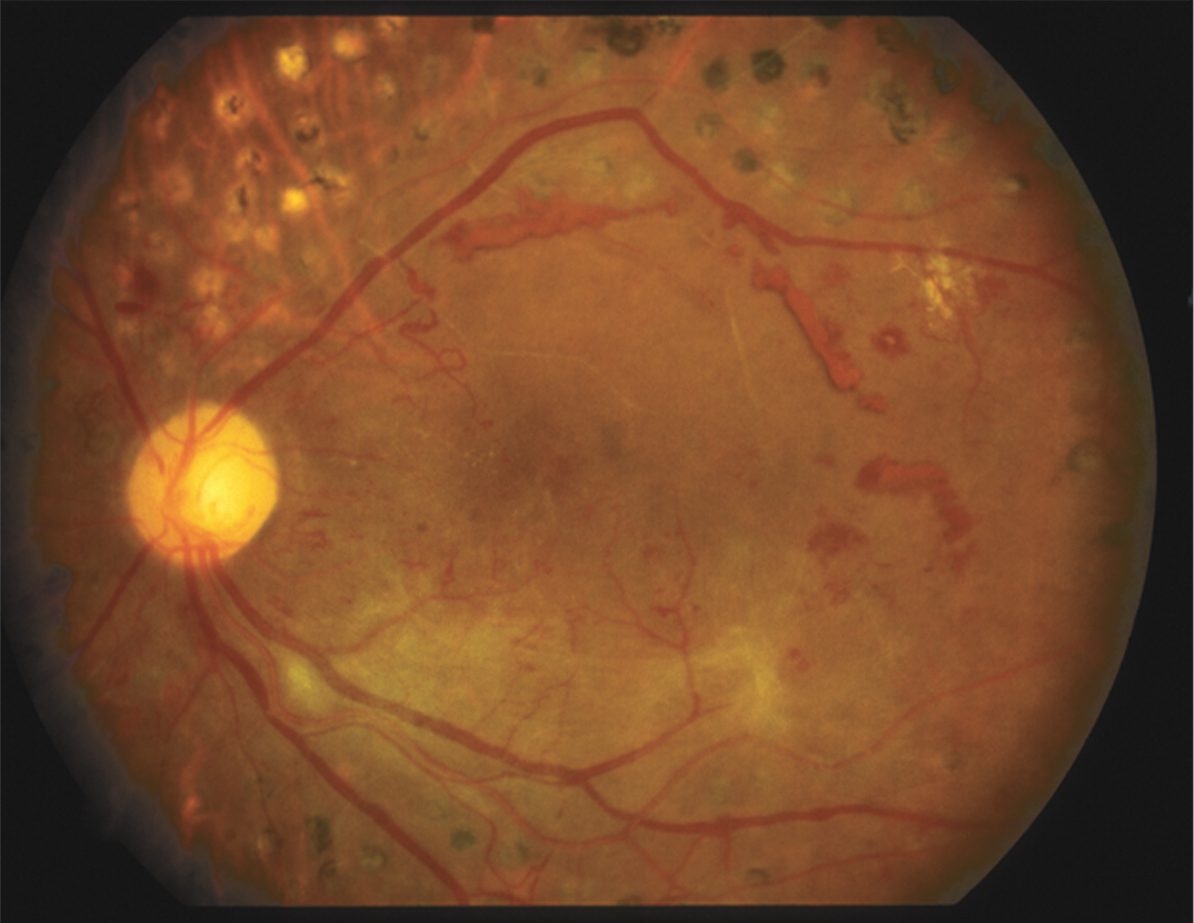 Diabetic Retinopathy
