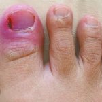 Ingrown toenail