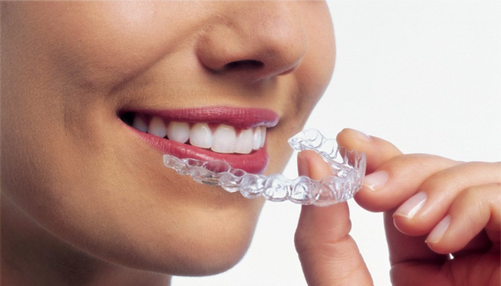 Invisalign Treatment