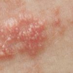 Shingles Outbreak