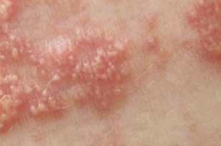 Shingles Outbreak