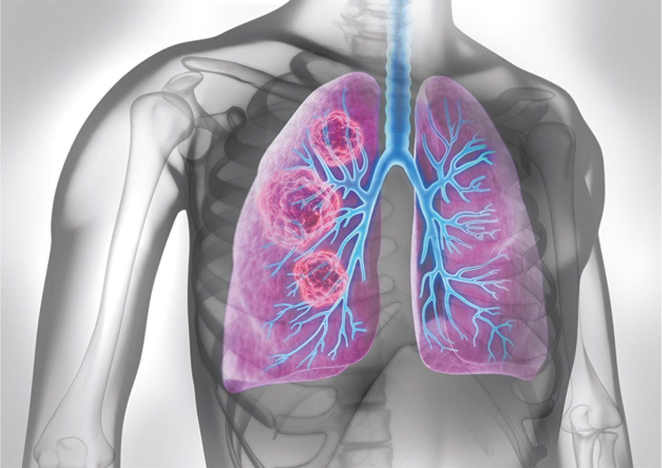 Lung Cancer screening