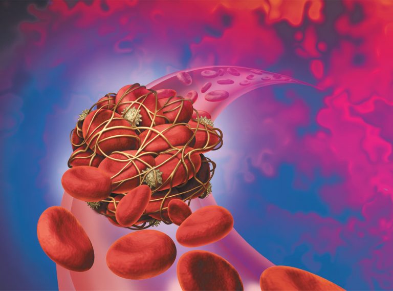 Take Steps to Stop the Clot Learn your risk factors to prevent life