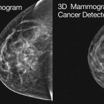 3D Mammography