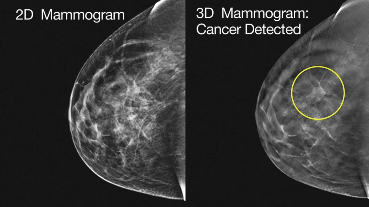 3D Mammography