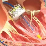 TAVR Surgery