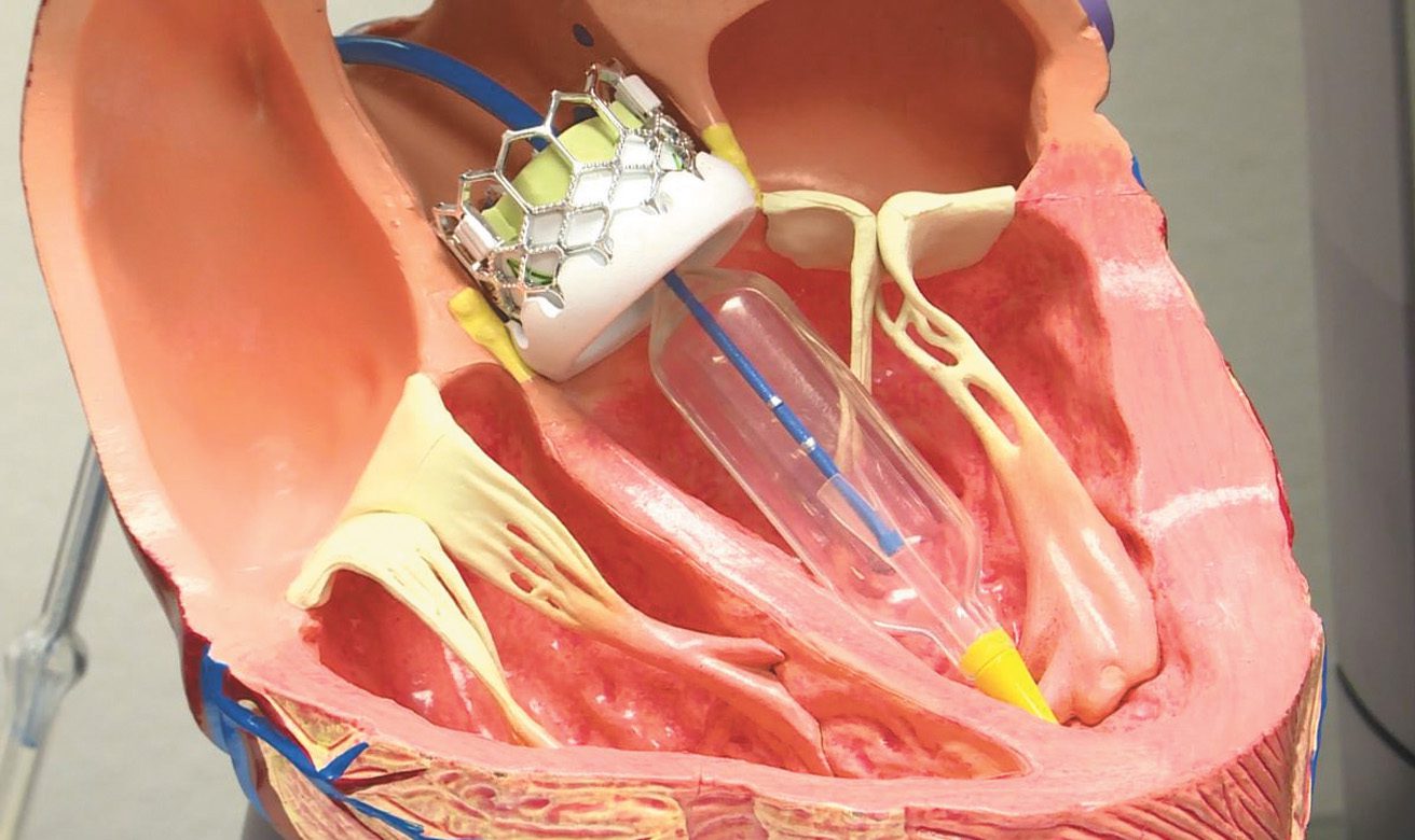 Houston Methodist Willowbrook now offers minimally invasive TAVR procedure,  providing faster recovery for patients with heart valve disease