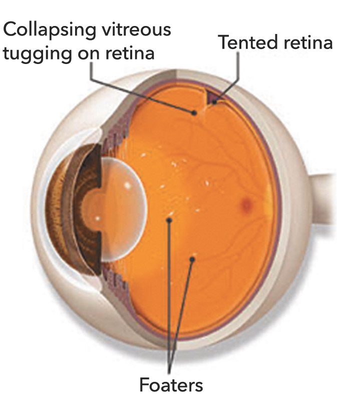 What Are Floaters and Flashes? Southwest Florida's Health and
