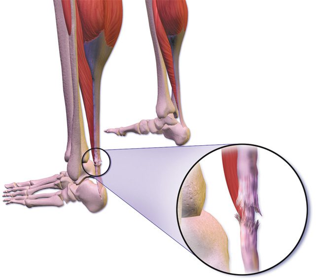Achilles Tendon