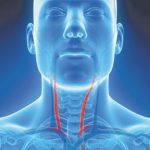 Carotid Stenosis