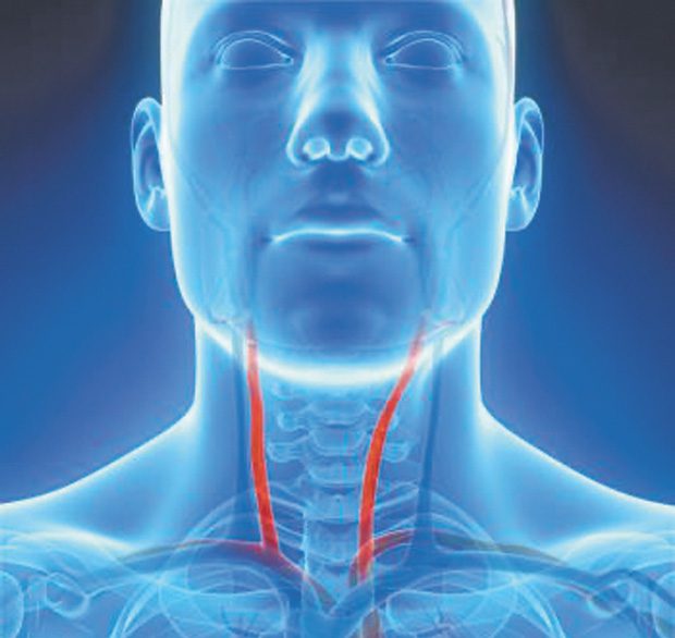 Treatment of Carotid Stenosis Reduces Risk of Stroke • Southwest ...