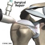 Labral Tear Surgery