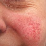 Redness of Rosacea