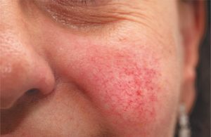 Redness of Rosacea