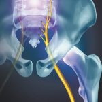 Sciatica Nerve Pain